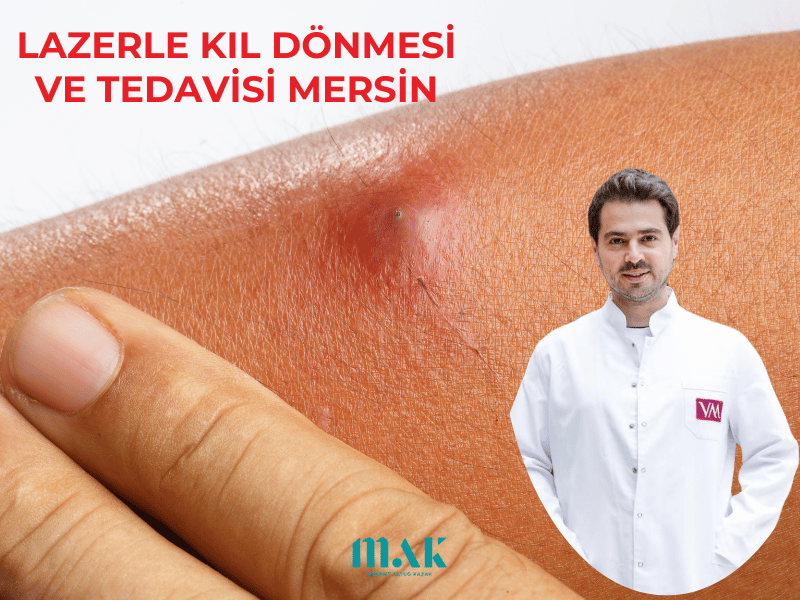 lazerle kıl dönmesi tedavisi mersin